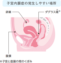 子宮内膜症の発生しやすい場所