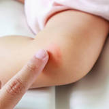 【医師監修】赤ちゃんの虫刺されにはどう対処する？　蚊に刺された時のケアと注意点
