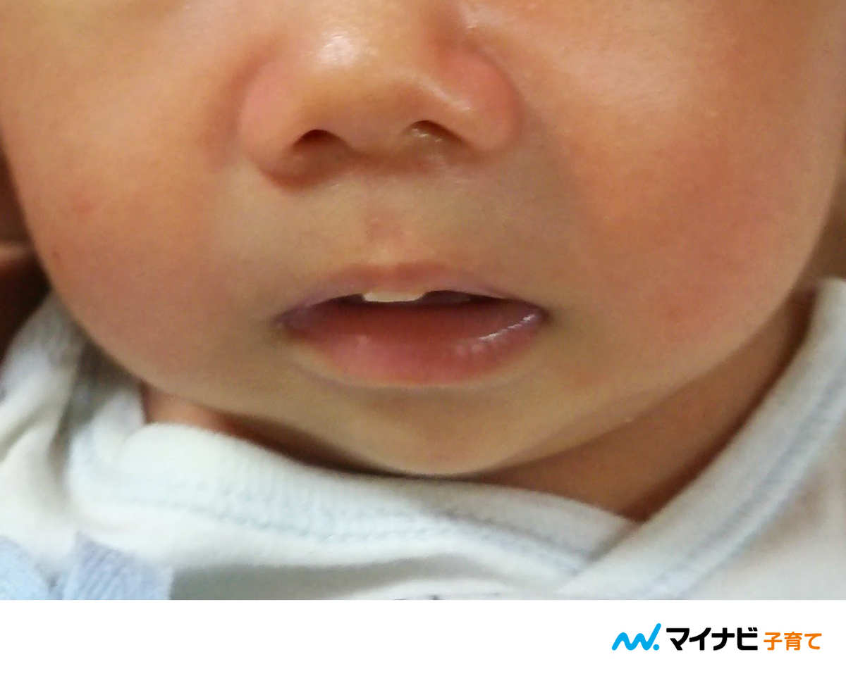 助産師解説 赤ちゃんの吸いだこ 唇にできる原因 対処法 マイナビ子育て