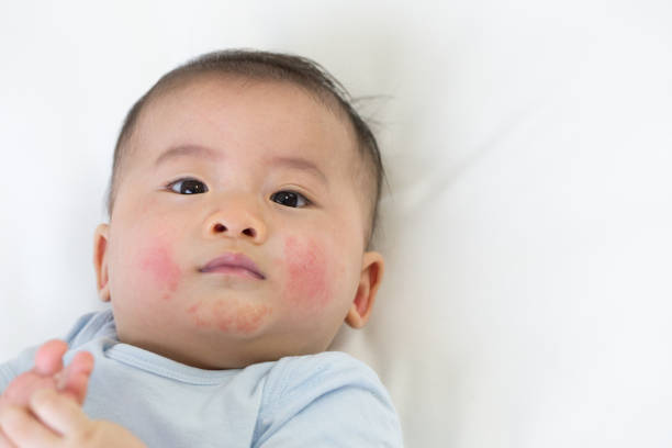 医師監修 タイプ別 乳児湿疹の原因と正しい対処法