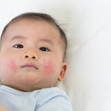 【医師監修】＜タイプ別＞乳児湿疹の原因と正しい対処法