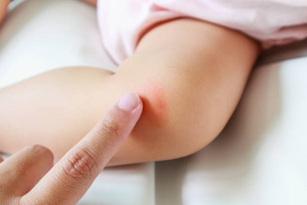 医師監修 赤ちゃんの虫刺されにはどう対処する 蚊に刺された時のケアと注意点