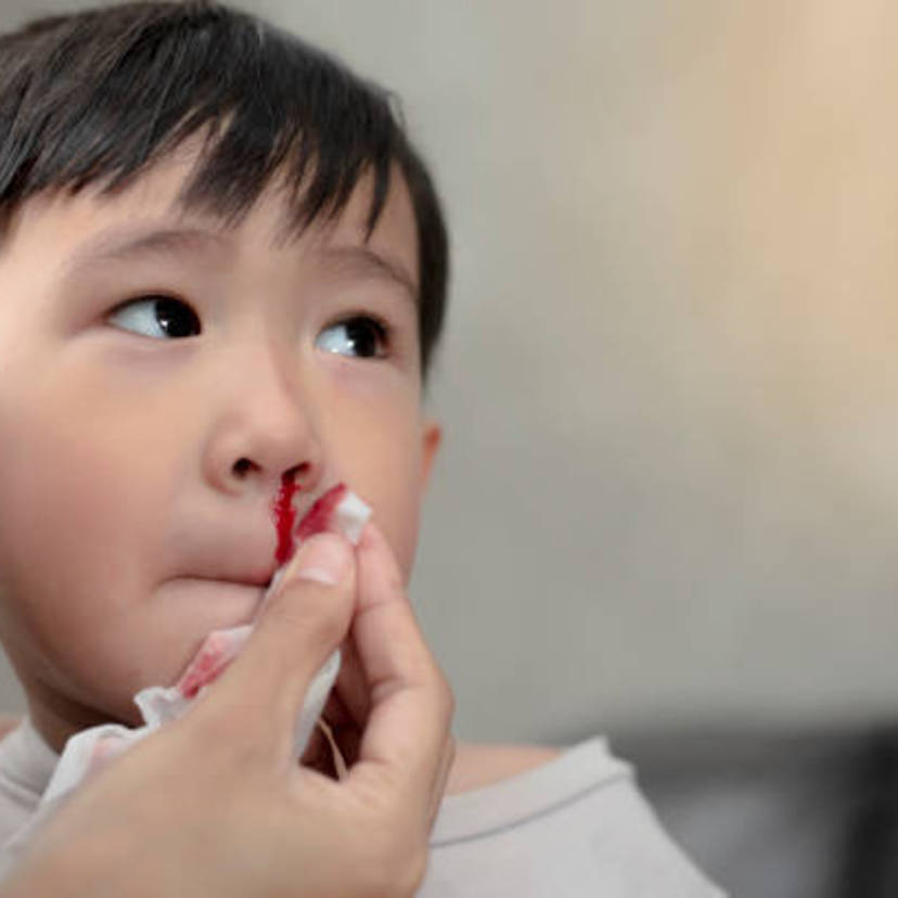 【医師解説】 子供や赤ちゃんの鼻血（鼻出血）は何が原因？ 対処法とやってはいけないこと