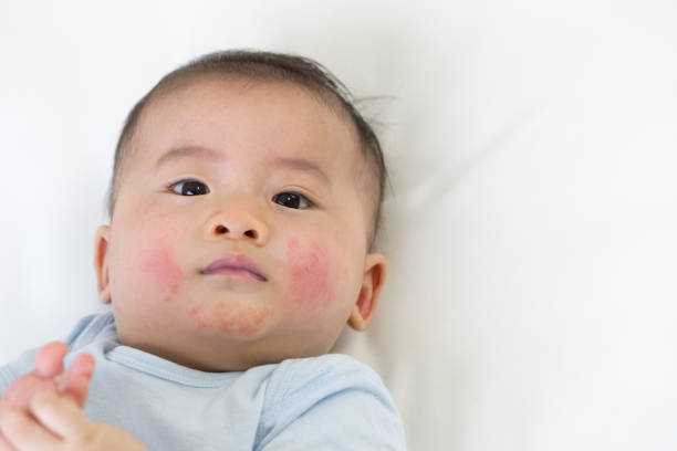 医師監修 タイプ別 乳児湿疹の原因と正しい対処法 マイナビウーマン子育て
