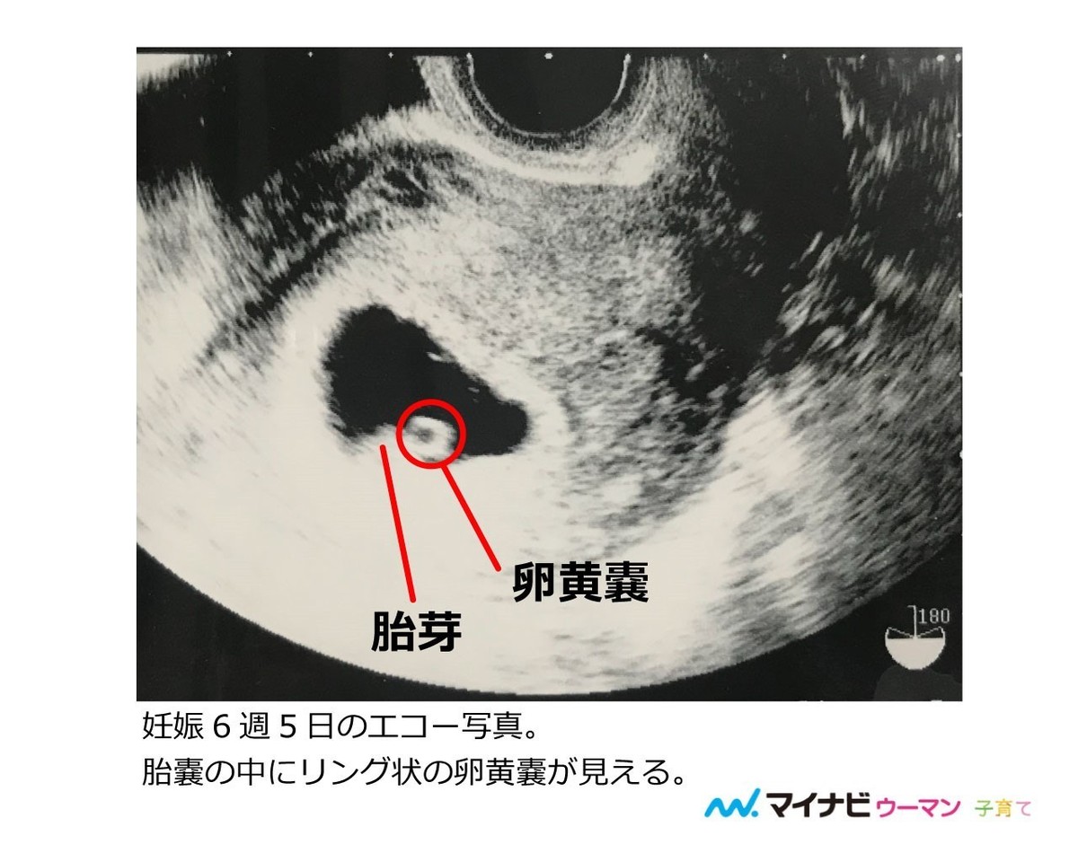 嚢 いつまで 卵黄 妊娠8週。心拍は確認できたけれど、卵黄嚢が大きいと言われ心配です。｜妊娠初期（1ヶ月,2ヶ月,3ヶ月,4ヶ月）｜ベビカム相談室｜ベビカム
