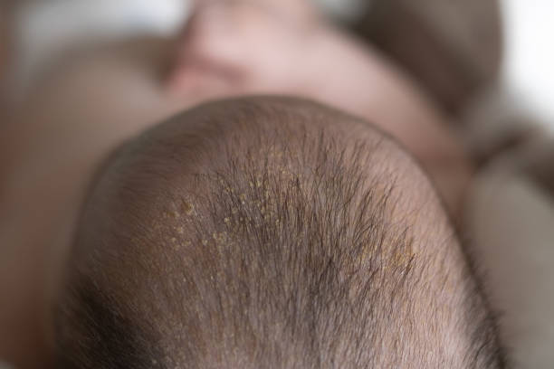 医師監修 新生児の湿疹の原因は どうやってケアすればいいの マイナビウーマン子育て Goo ニュース
