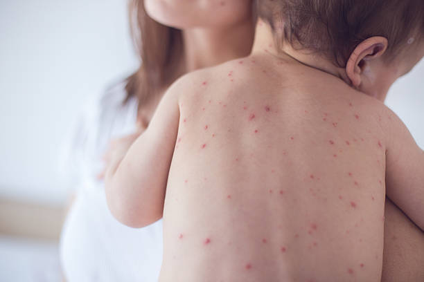赤い発疹 熱なし かゆみなし 子どもの発疹 熱なし かゆみあり 蕁麻疹やとびひかも 医師監修
