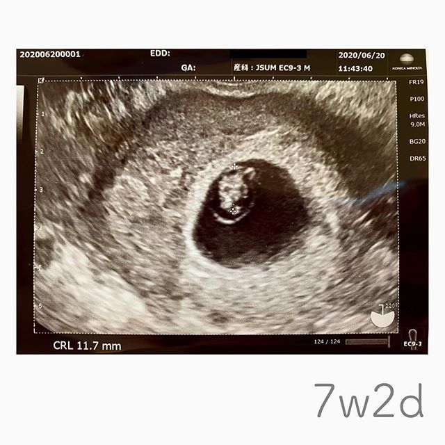 医師監修 妊娠7週のエコー写真を多数掲載 みんなのエピソードつき Michill ミチル