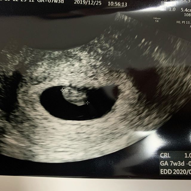 医師監修 妊娠7週のエコー写真 胎盤が作られ始めるころ マイナビ子育て