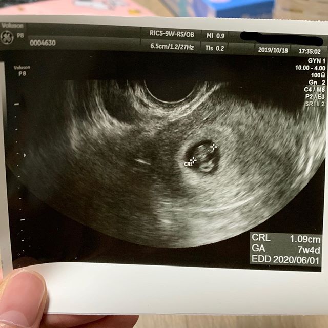 医師監修 妊娠7週のエコー写真 胎盤が作られ始めるころ マイナビ子育て