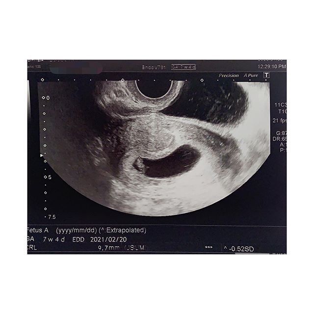 医師監修 妊娠7週のエコー写真を多数掲載 みんなのエピソードつき マイナビウーマン子育て Goo ニュース