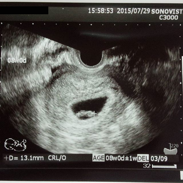 医師監修 妊娠8週のエコー写真を多数掲載 みんなのエピソードつき マイナビ子育て
