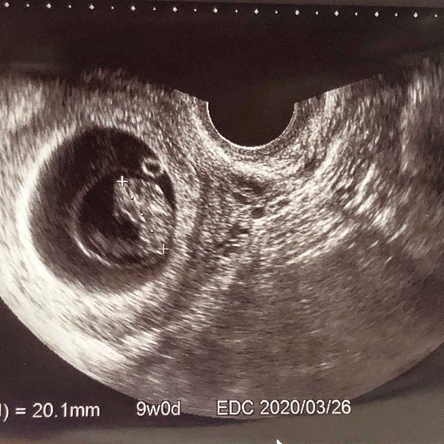 医師監修 妊娠9週 のエコー写真を多数掲載 みんなのエピソードつき マイナビウーマン子育て 妊婦健診でもらう エコー 超音波 検査 ｄメニューニュース Nttドコモ