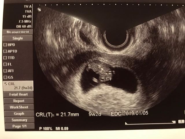 医師監修 妊娠9週のエコー写真 手足が動かしはじめることも マイナビ子育て