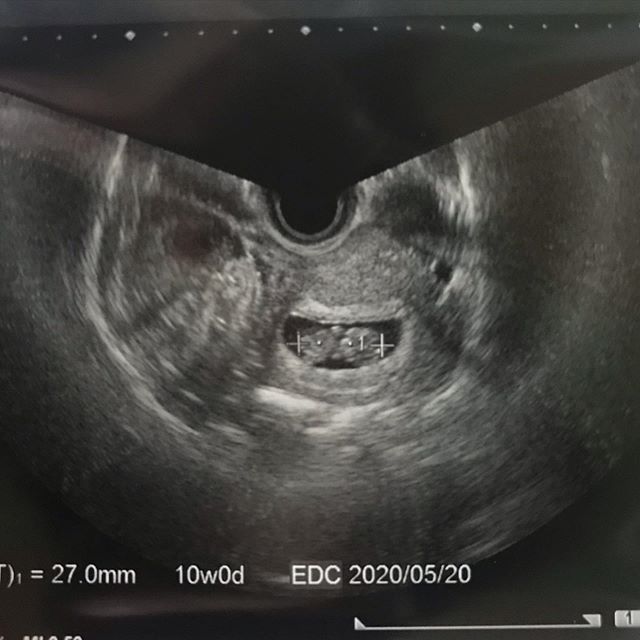 医師監修 妊娠10週のエコー写真を多数掲載 みんなのエピソードつき マイナビウーマン子育て 妊婦健診でもらう エコー 超音波 検査 ｄメニューニュース Nttドコモ