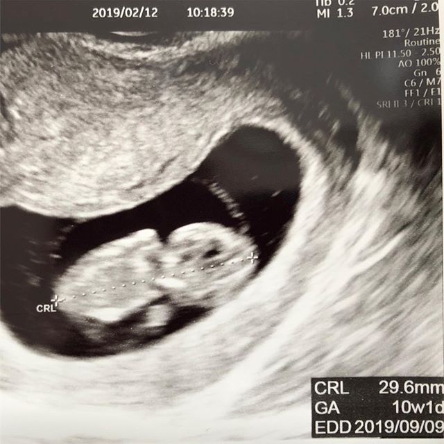 医師監修 妊娠10週のエコー写真 外見がヒトらしくなってくる マイナビ子育て