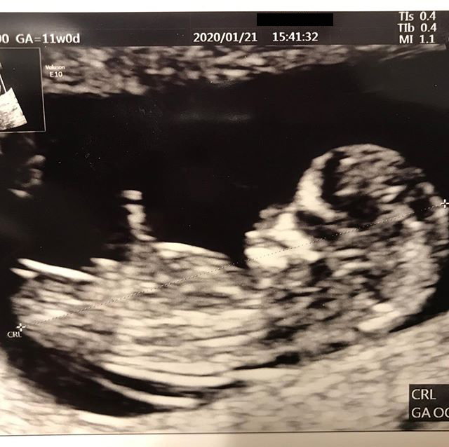 医師監修 妊娠11週のエコー写真 ヒトらしい形になる マイナビ子育て