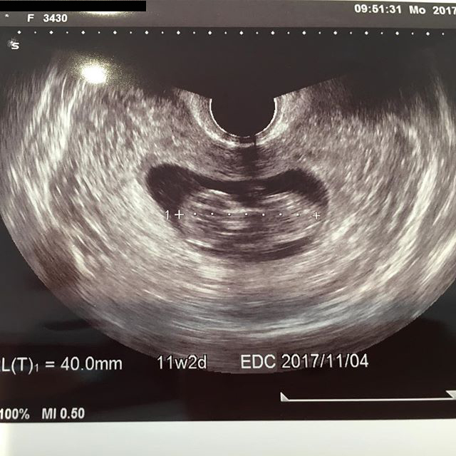 医師監修 妊娠11週のエコー写真 ヒトらしい形になる マイナビ子育て