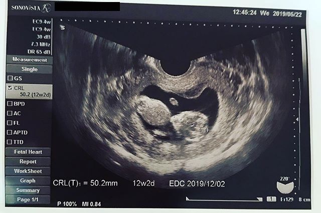 医師監修 妊娠12週のエコー写真付 内臓がほぼ完成 マイナビ子育て