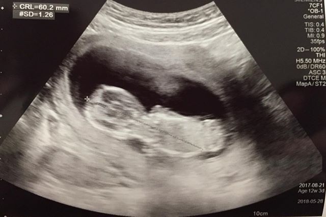 医師監修 妊娠12週のエコー写真を多数掲載 みんなのエピソードつき マイナビウーマン子育て Goo ニュース