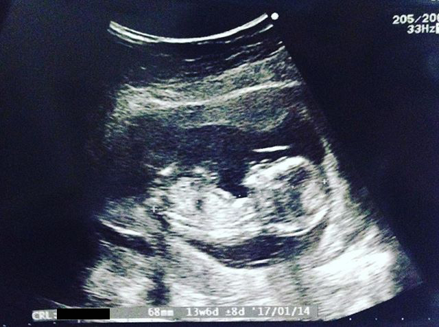 医師監修 妊娠13週のエコー写真付 赤ちゃんの心拍数が安定するころ マイナビウーマン子育て