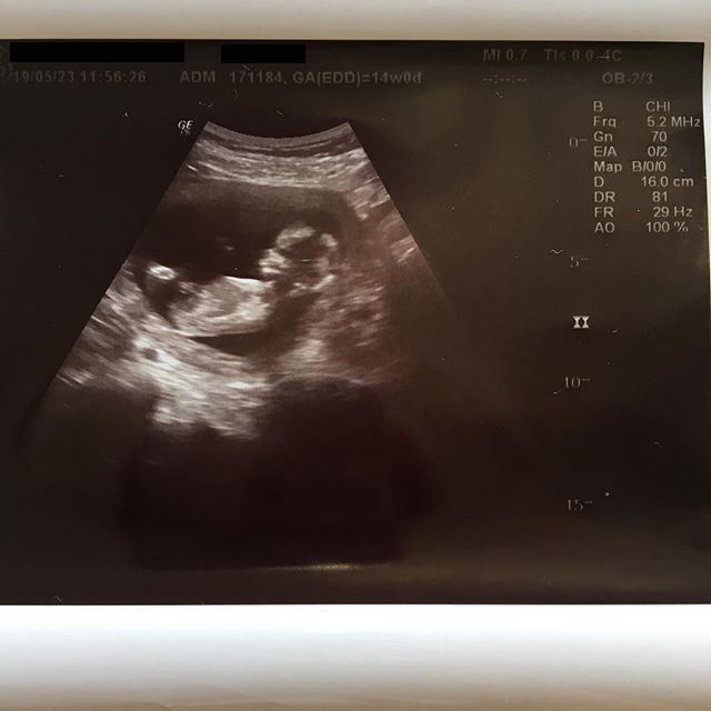 医師監修 妊娠14週のエコー写真 手足を動かす様子が見られる マイナビ子育て