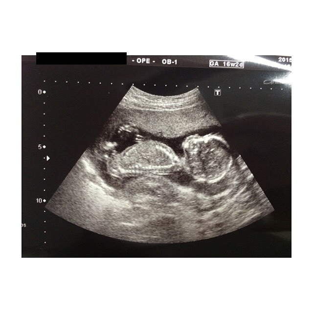 医師監修 妊娠16週のエコー写真 呼吸する様な動きがみられることも マイナビ子育て