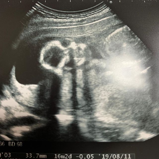医師監修 妊娠16週のエコー写真 呼吸する様な動きがみられることも マイナビウーマン子育て