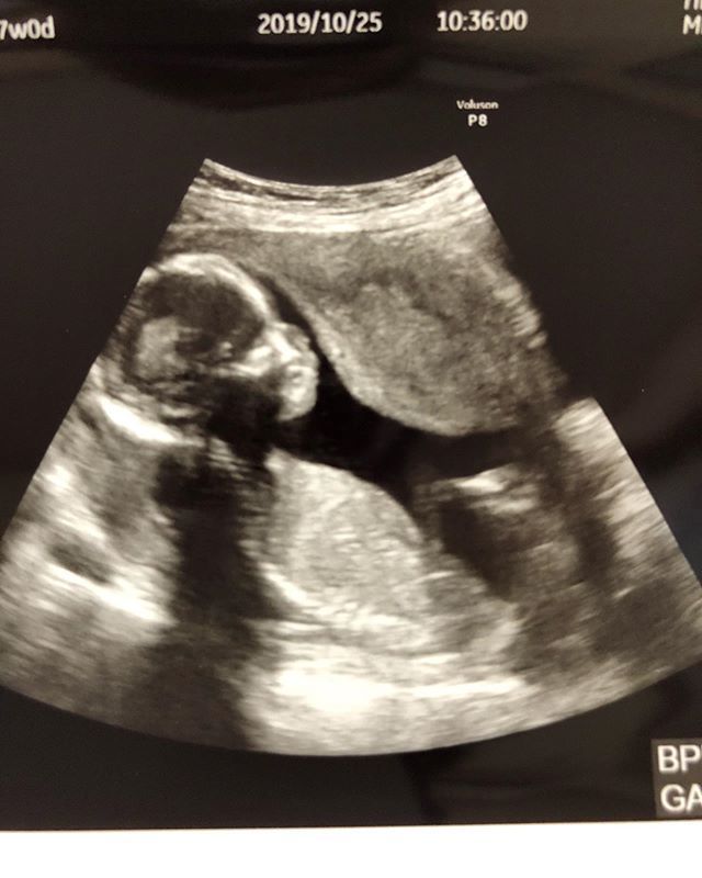 医師監修 妊娠17週のエコー写真 性別がわかることも マイナビウーマン子育て