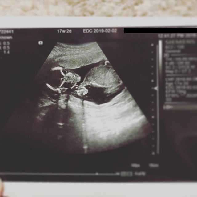 医師監修 妊娠17週のエコー写真を多数掲載 みんなのエピソードつき マイナビウーマン子育て 妊婦健診でもらう エコー 超音波 検査 ｄメニューニュース Nttドコモ