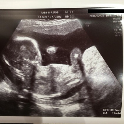 医師監修 妊娠17週のエコー写真を多数掲載 みんなのエピソードつき マイナビウーマン子育て 妊婦健診でもらう エコー 超音波 検査 ｄメニューニュース Nttドコモ