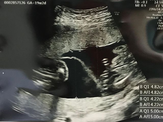 医師監修 妊娠19週のエコー写真を多数掲載 みんなのエピソードつき マイナビウーマン子育て 妊婦健診でもらう エコー 超音波 検査 ｄメニューニュース Nttドコモ