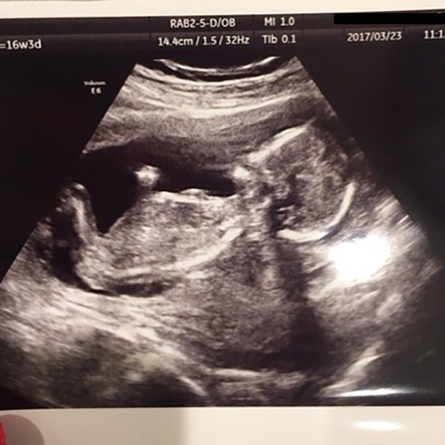 医師監修 妊娠16週のエコー写真 呼吸する様な動きがみられることも マイナビ子育て