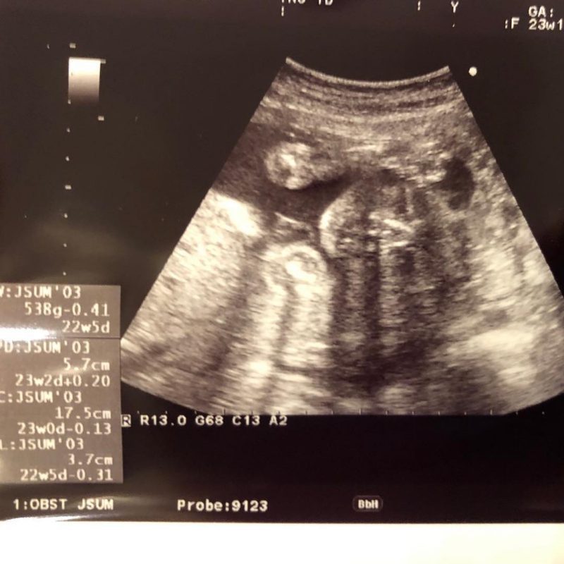 医師監修 妊娠23週のエコー写真 物音に反応してびっくり マイナビウーマン子育て