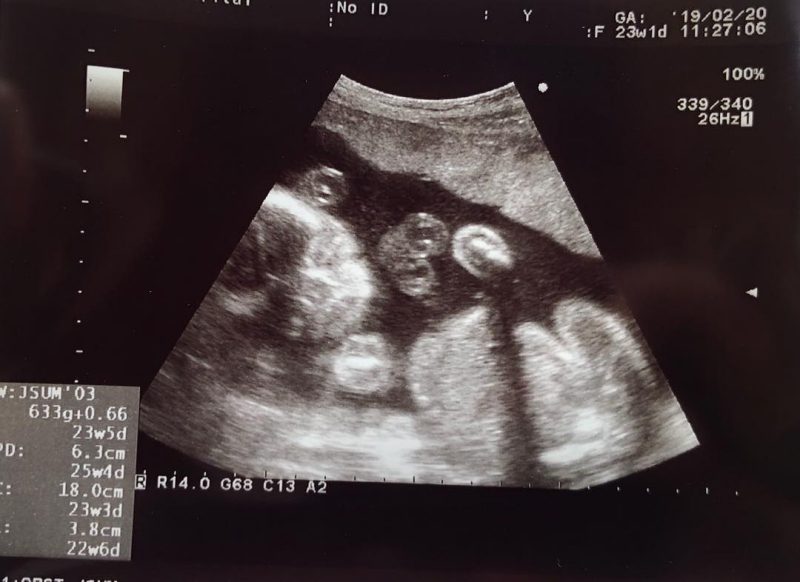 医師監修 妊娠23週のエコー写真 物音に反応してびっくり マイナビ子育て