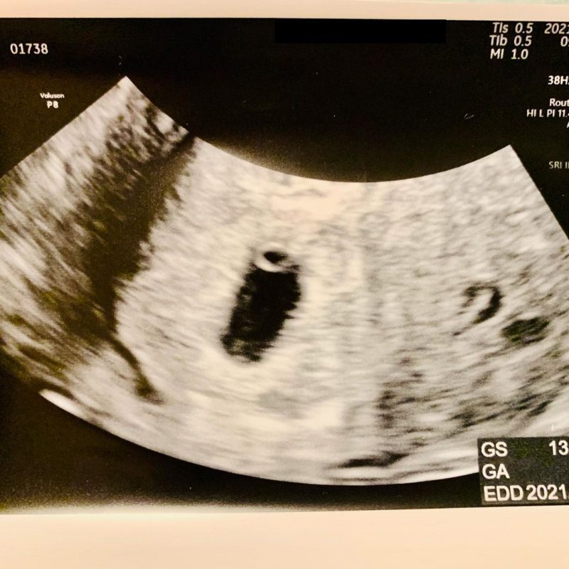 医師監修 妊娠6週のエコー写真 心拍が確認できるころ マイナビ子育て