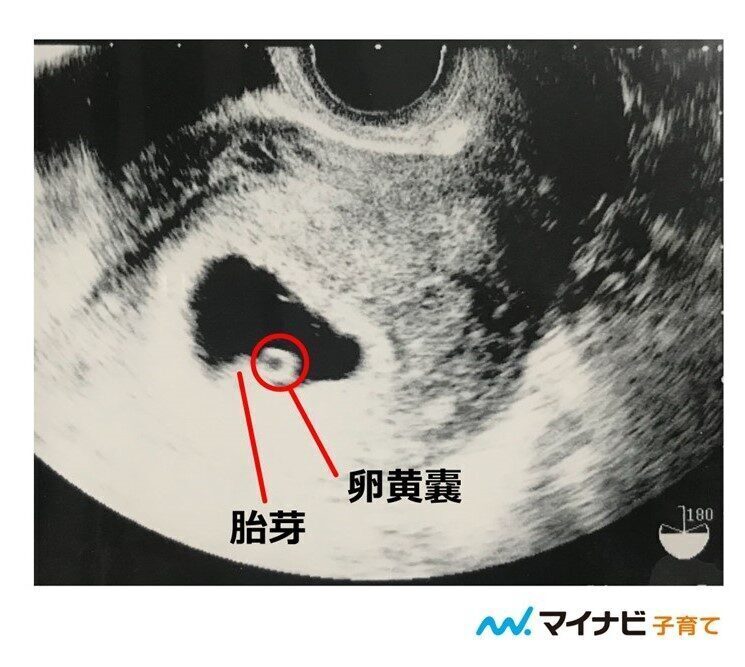 医師監修 胎嚢確認の時期はいつ 胎嚢や胎芽が見えない原因 マイナビ子育て