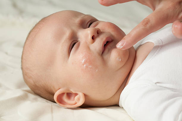 医師監修 タイプ別 乳児湿疹の原因と正しい対処法 マイナビ子育て